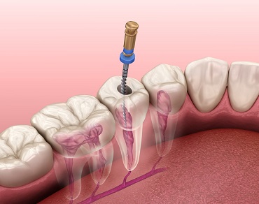 جراحی و درمان ریشه دندان