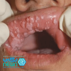 درمان زگیل دهانی