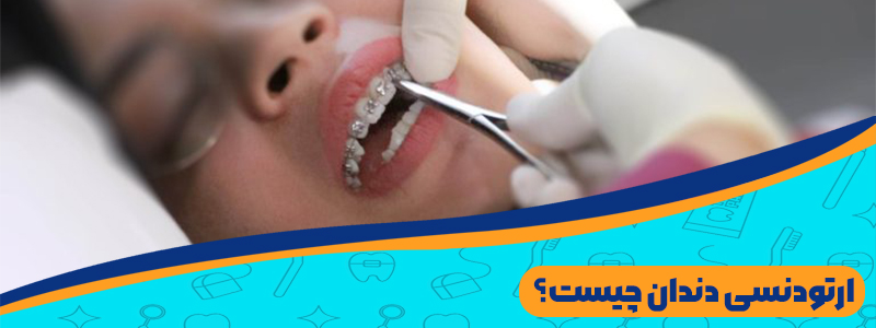 ارتودنسی دندان چیست؟ انواع ارتودنسی دندان