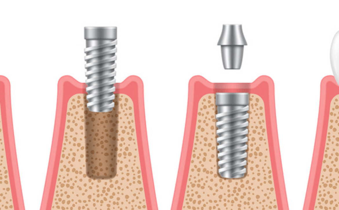 ایمپلنت دندان 1