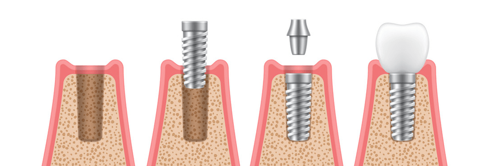 ایمپلنت-دندان