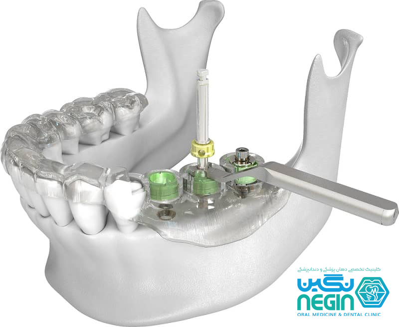ایمپلنت دندان به روش دیجیتالی