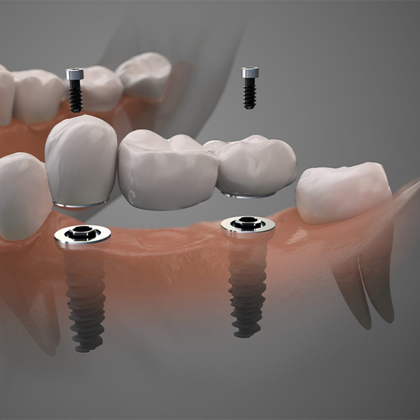 ایمپلنت دندان به روش معمولی (سنتی)