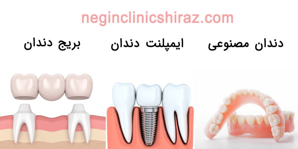 تفاوت ایمپلنت دندان با دندان مصنوعی