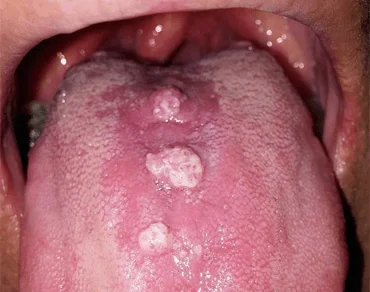 غربالگری سریع زگیل HPV دهانی 1