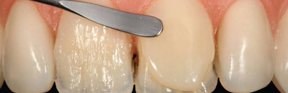 تفاوت لمینت دندان با کامپوزیت