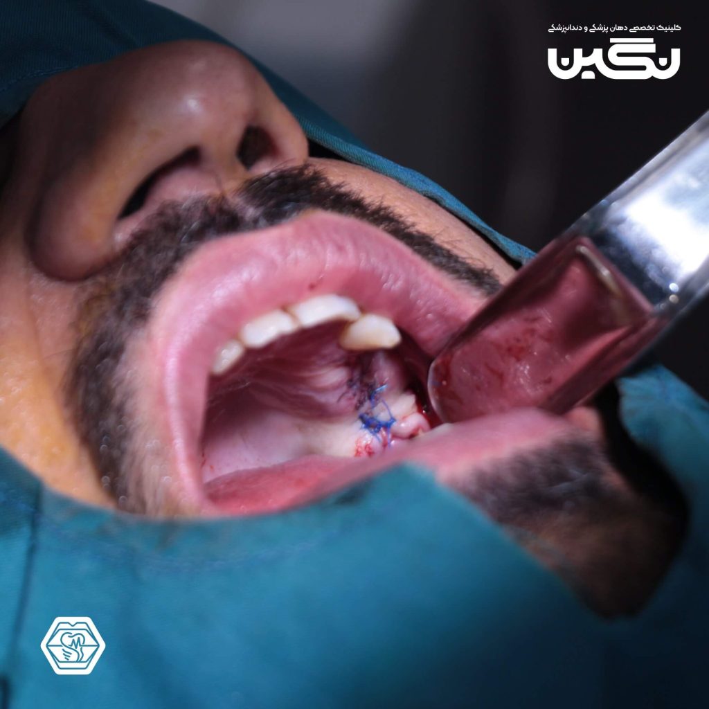 ایمپلنت دندان در شیراز