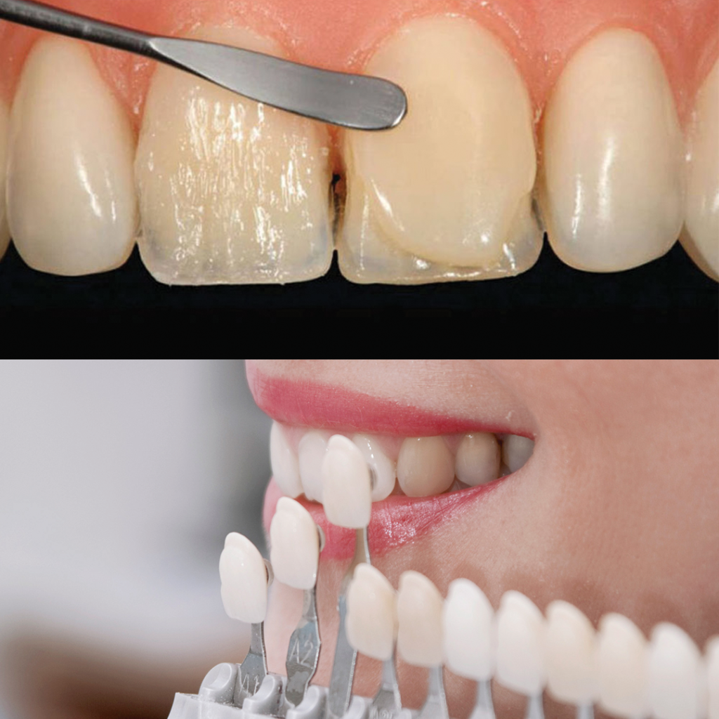 تفاوت لمینت دندان با کامپوزیت