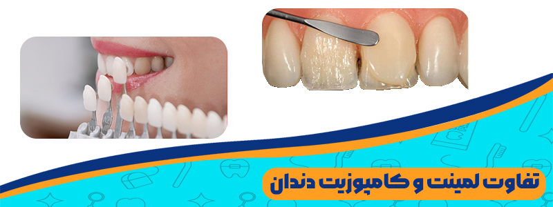 تفاوت لمینت دندان و کامپوزیت در چیست؟