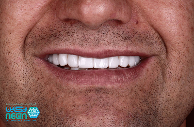 لمینت دندان شیراز- کلینیک دندانپزشکی نگین