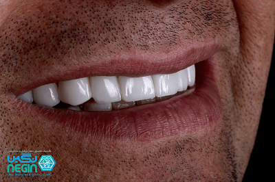 لمینت دندان شیراز- کلینیک دندانپزشکی نگین