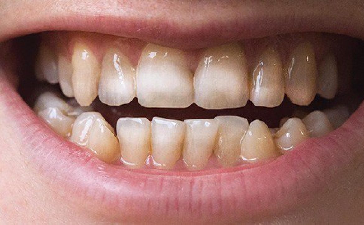 مینای دندان 2