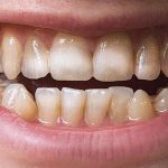 مینای دندان چیست؟ جلوگیری از فرسایش مینای دندان