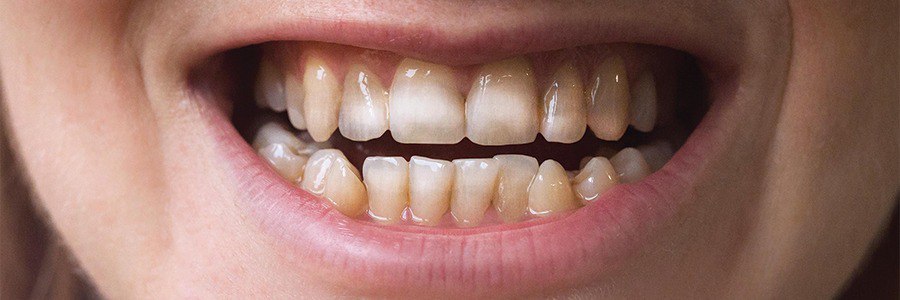 مینای دندان 2