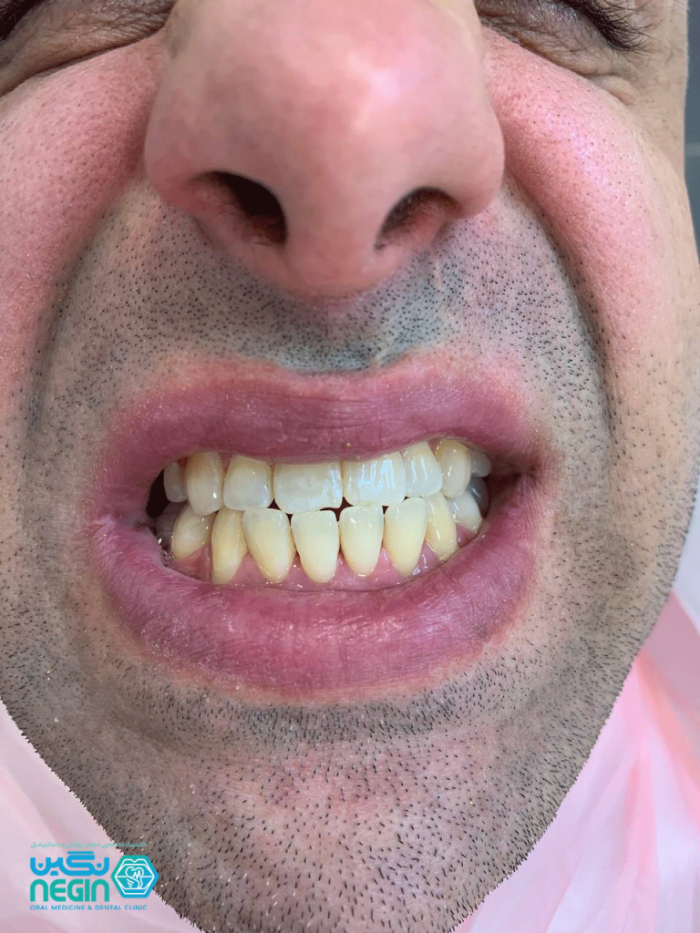 مزایای بلیچینگ دندان