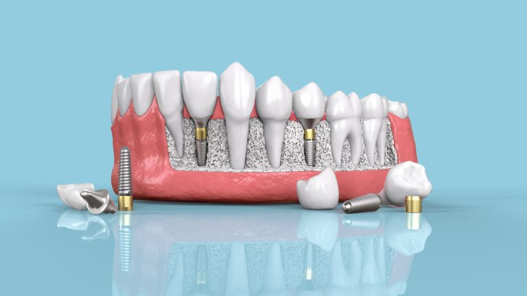 01 guide implant dentaire 768x432 1