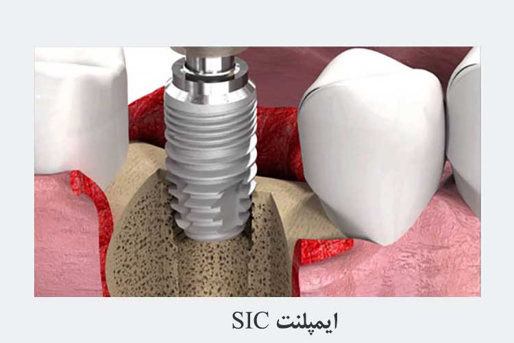 swiss dental implant sic