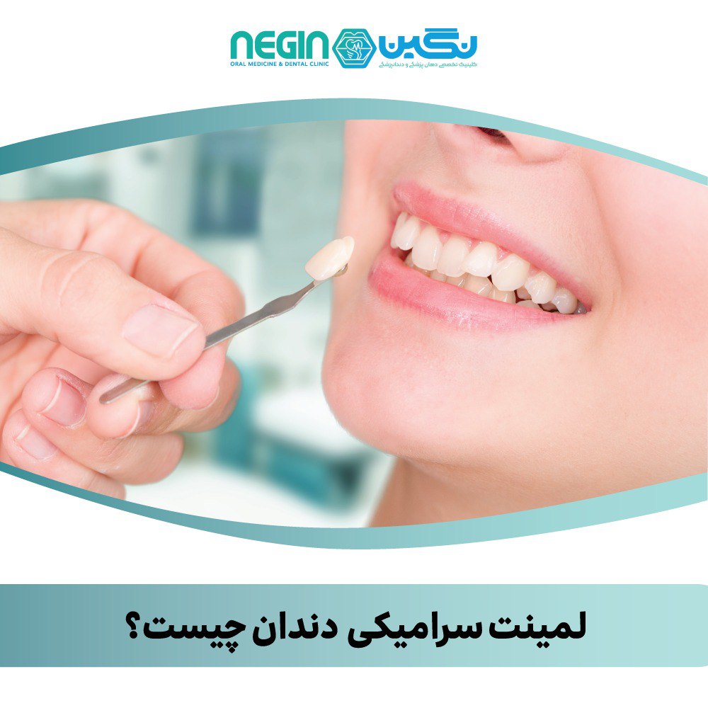 لمینت سرامیکی دندان چیست؟ کلینیک دندانپزشکی نگین