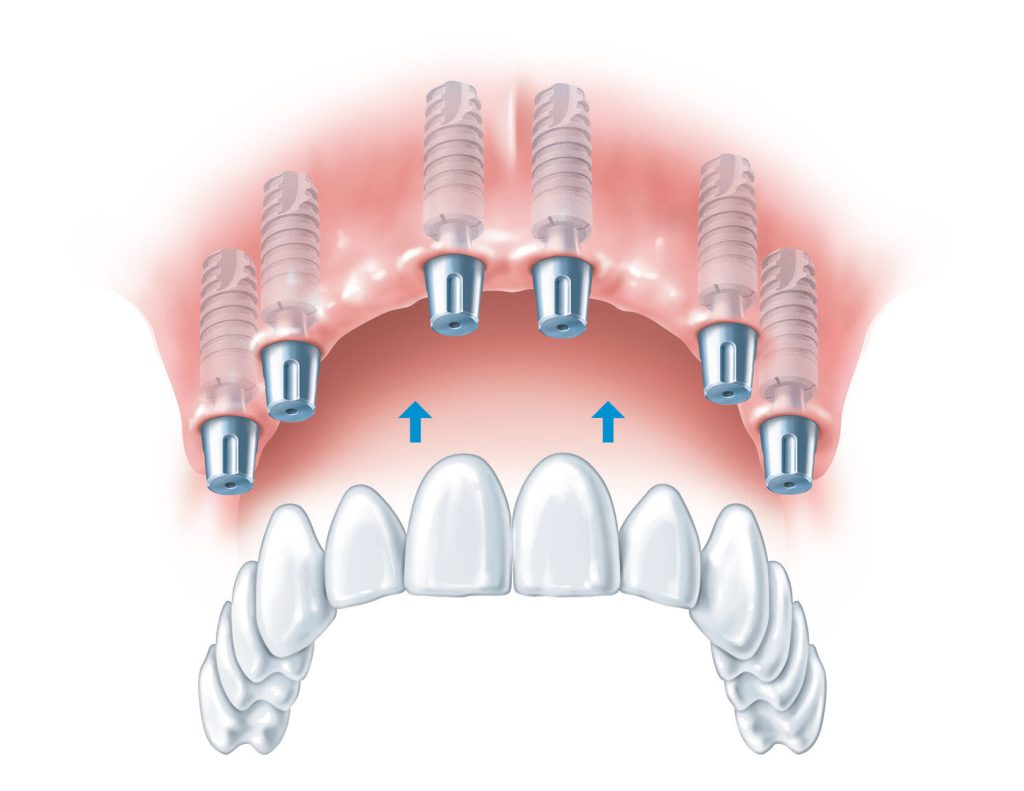 ایمپلنت دیجیتال دندان