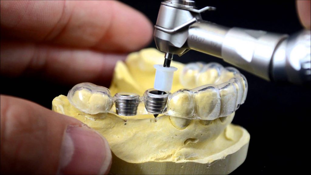 ایمپلنت دیجیتال دندان