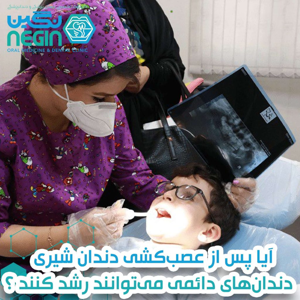 عصب کشی دندان کودکان در شیراز