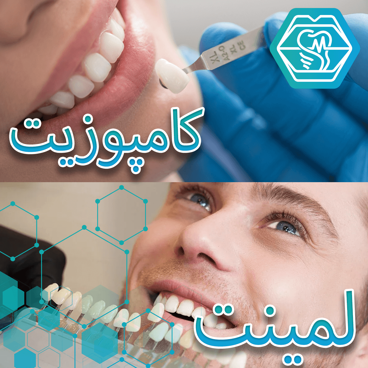 لمینت دندان و کامپوزیت دندان - کلینیک دندانپزشکی نگین