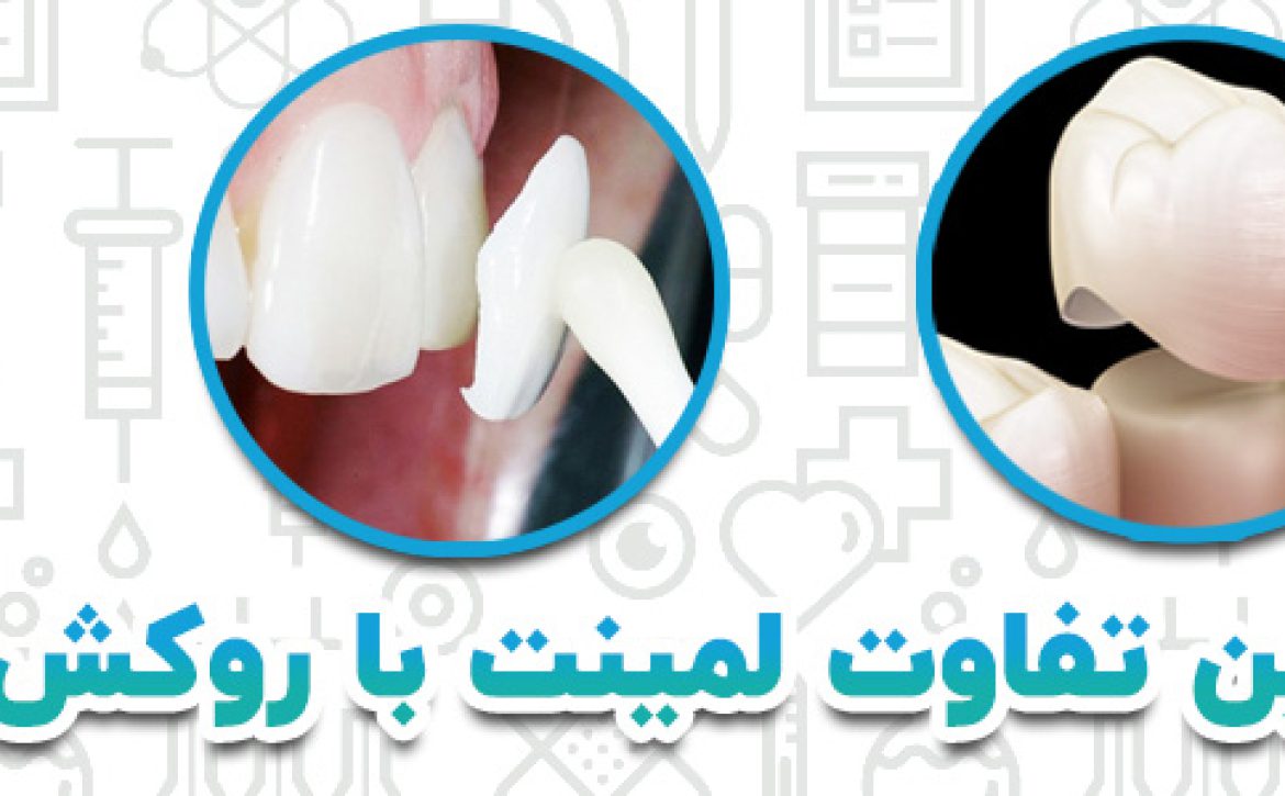 مهمترین تفاوت روکش با لمینت دندان 1