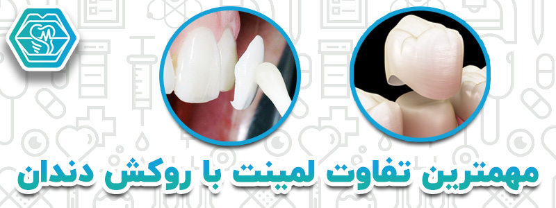 مهمترین تفاوت روکش با لمینت دندان