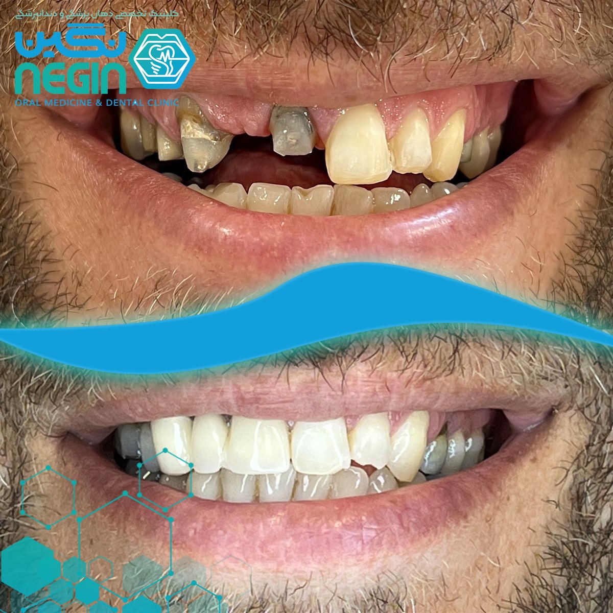نمونه کار لمینت دندان در شیراز (4)