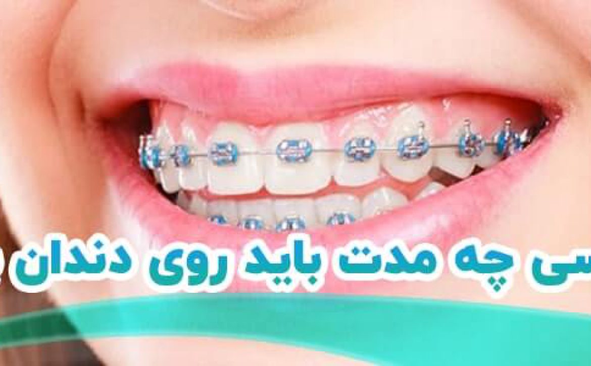 ارتودنسی چه مدت زمان باید روی دندان بماند؟