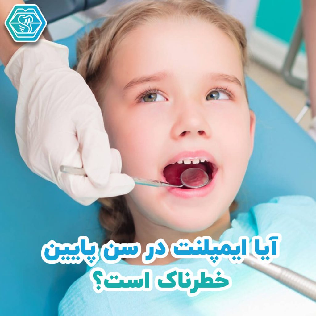 ایمپلنت دندان در شیراز - کلینیک نگین
