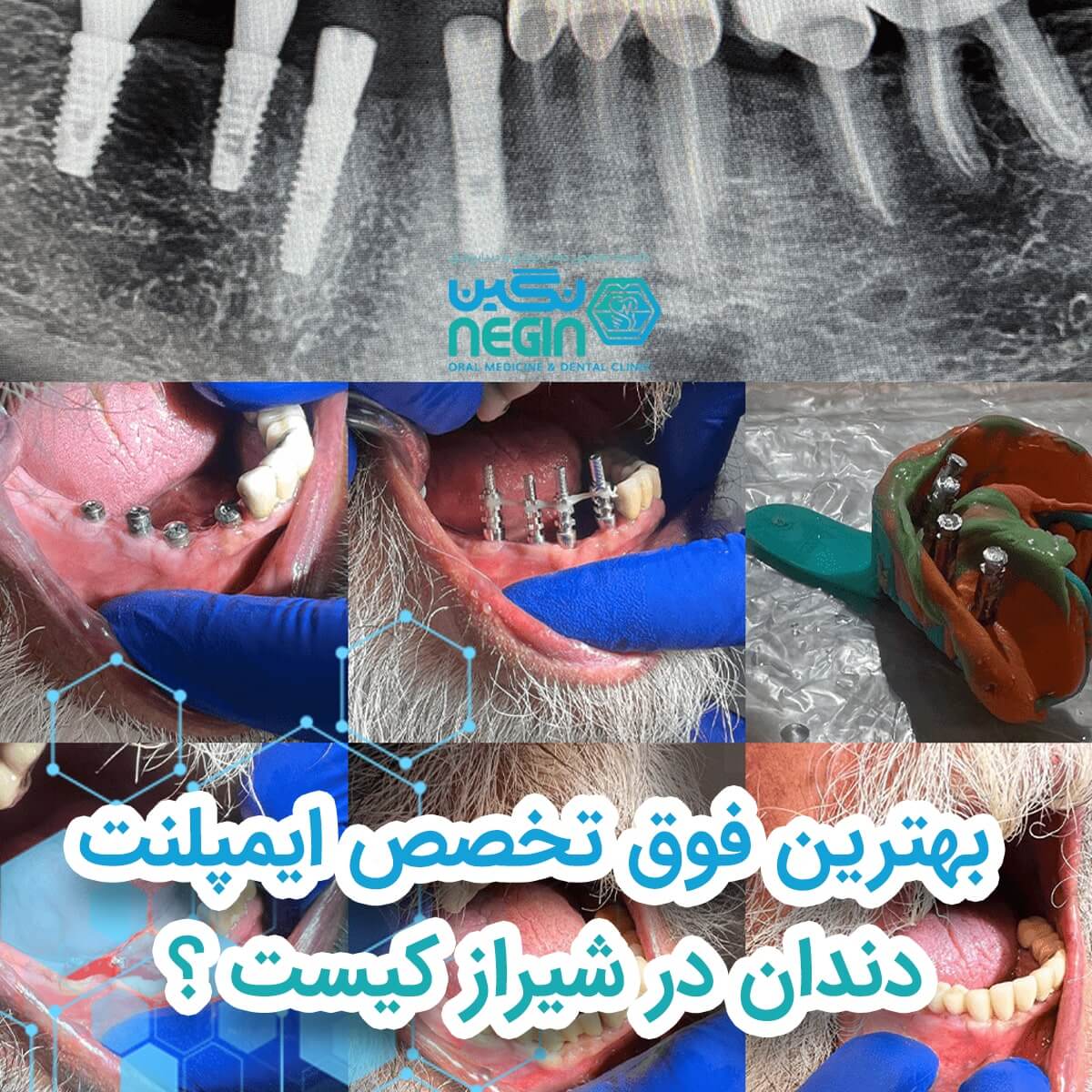 بهترین فوق تخصص ایمپلنت دندان در شیراز کیست ؟