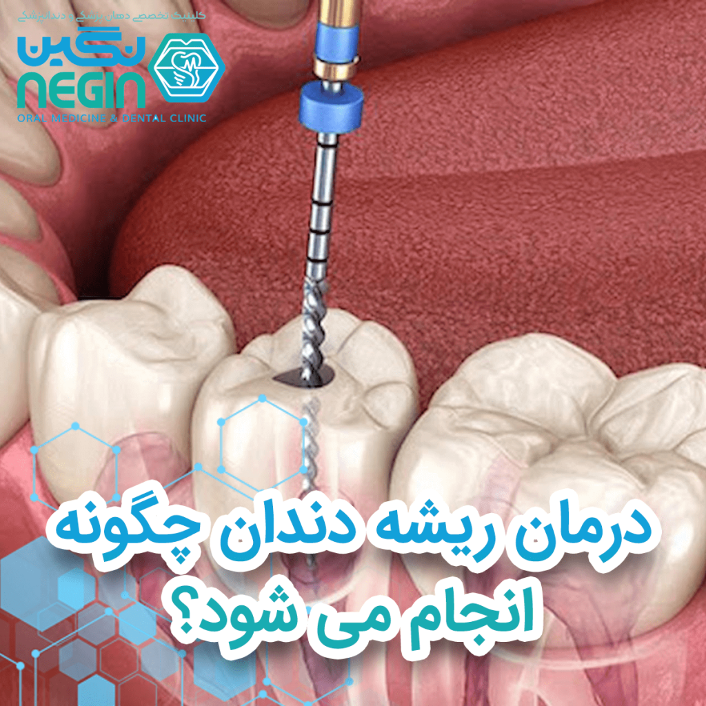 عصب کشی دندان در شیراز 