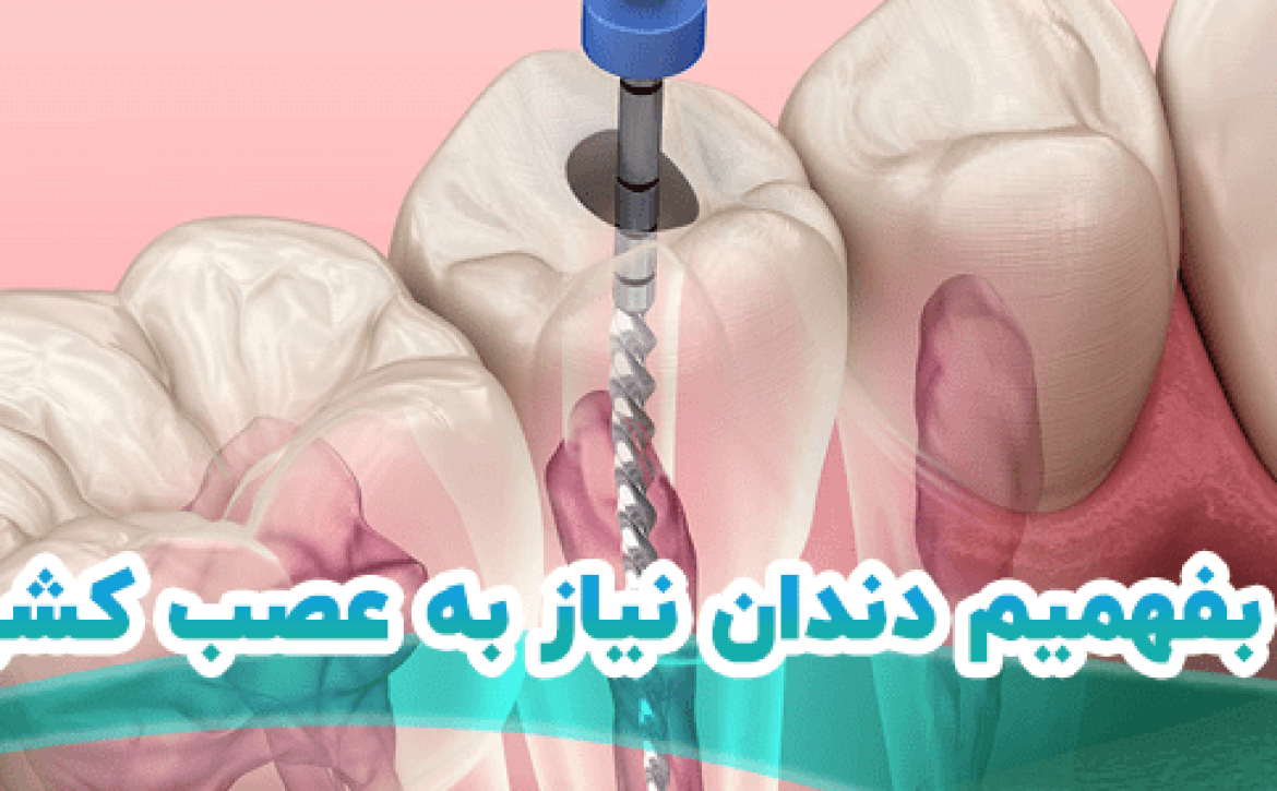 عصب کشی دندان در شیراز 6