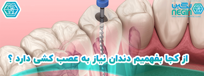 عصب کشی دندان در شیراز