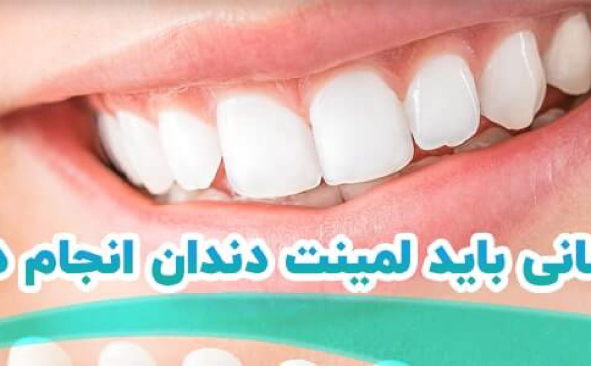 لمینت دندان در شیراز کلینیک نگین 1