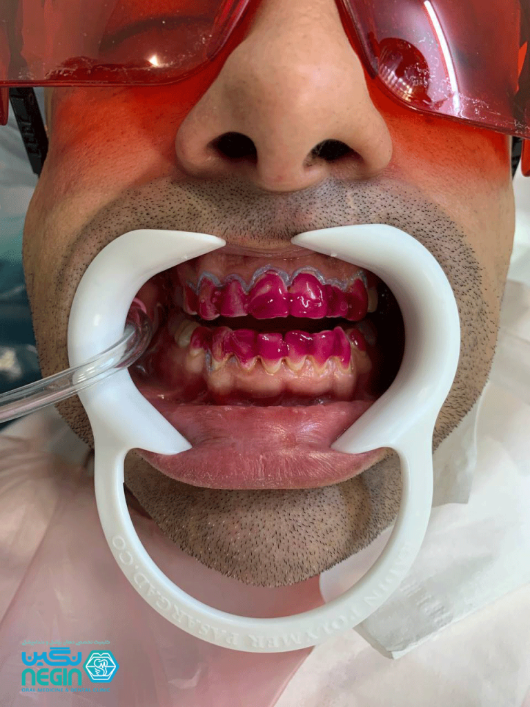 بلیچینگ دندان