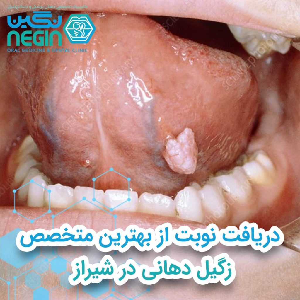 دریافت نوبت از بهترین متخصص زگیل دهانی در شیراز
