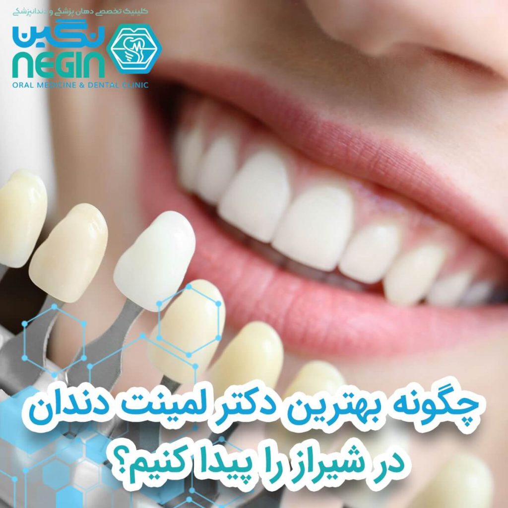 چگونه بهترین دکتر لمینت دندان در شیراز را پیدا کنیم؟