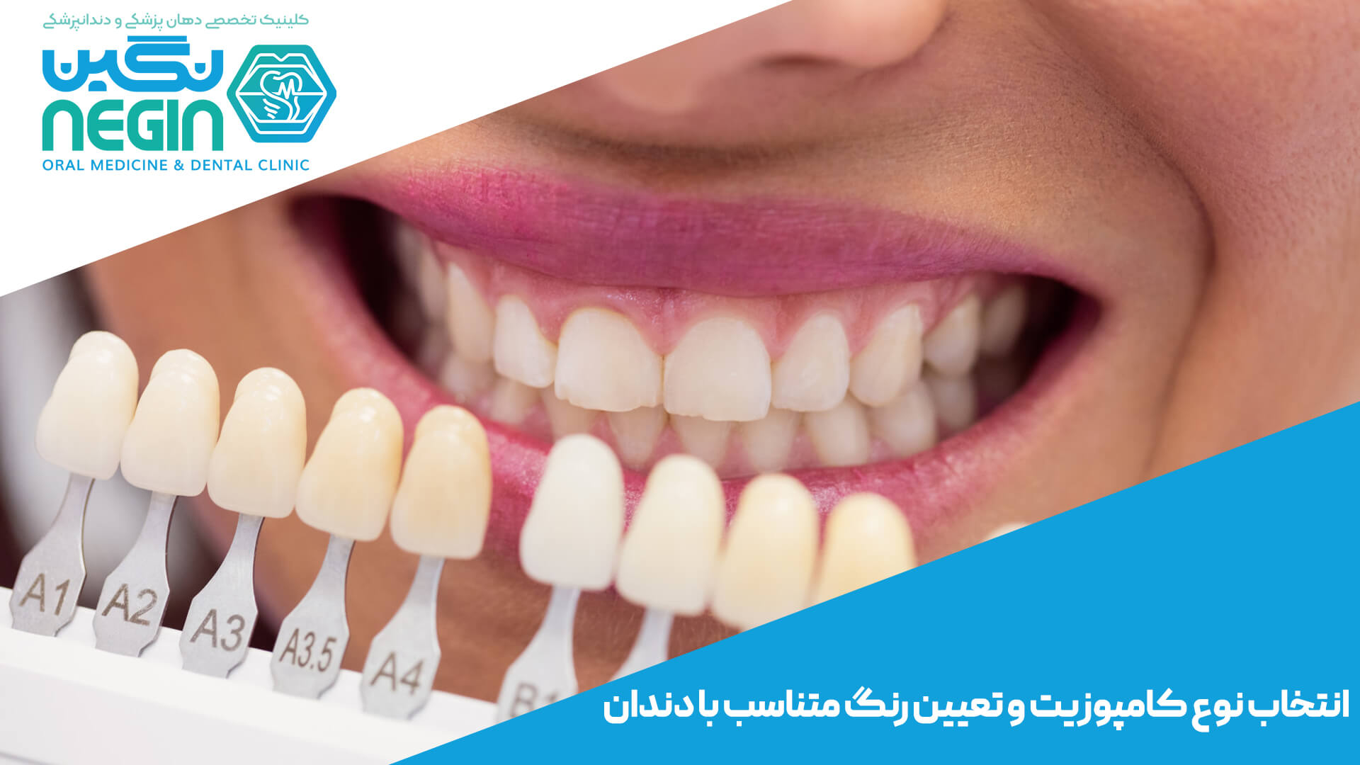 مراحل انجام ونیر کامپوزیت دندان در شیراز - کلینیک دندانپزشکی نگین