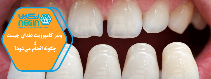 دوام ونیر کامپوزیت و عوامل موثر بر آن- کلینیک دندانپزشکی نگین