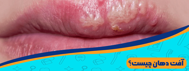 آفت دهان چیست؟ راه های درمان آفت دهانی