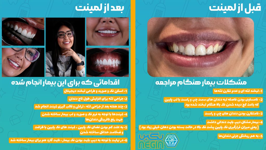 اقدامات قبل و بعد از لمینت دندان در شیراز