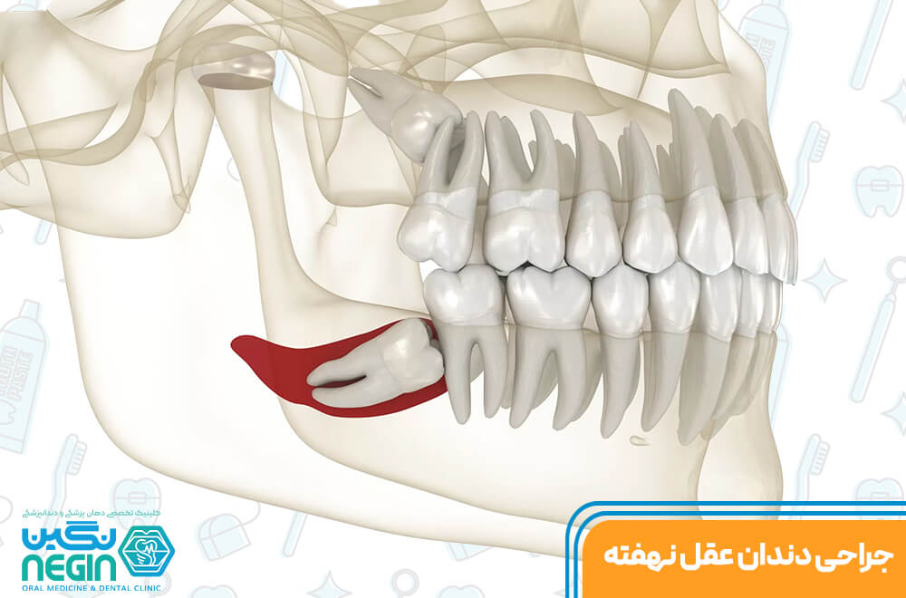 جراحی دندان عقل نهفته در شیراز