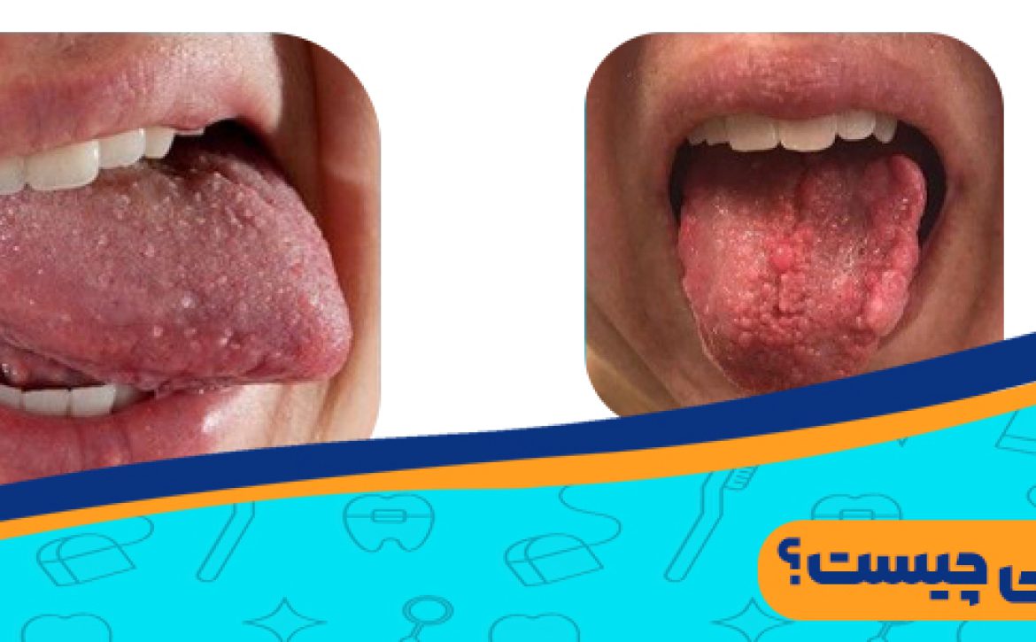 زگیل دهانی چیست؟ چرا باید سریع درمان شود؟