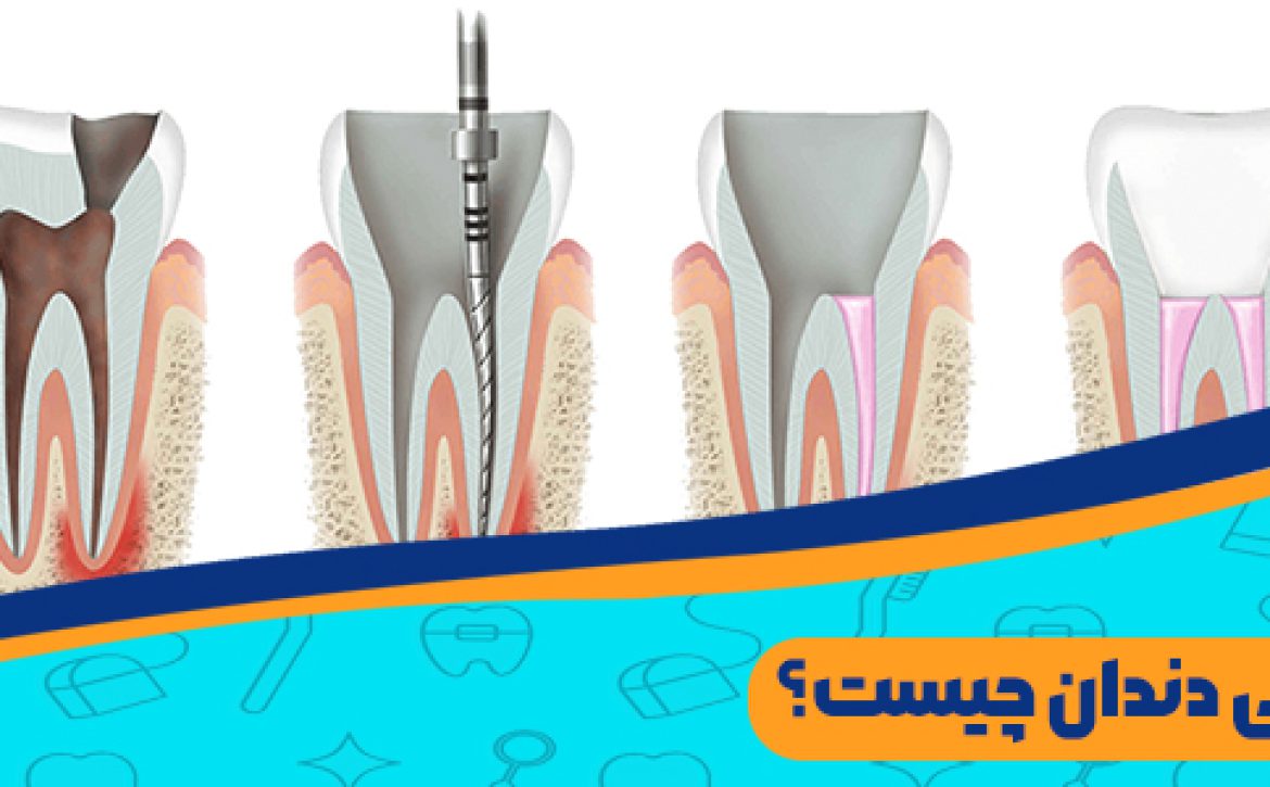 عصب کشی دندان چیست؟ بررسی کامل مراحل عصب‌ کشی دندان