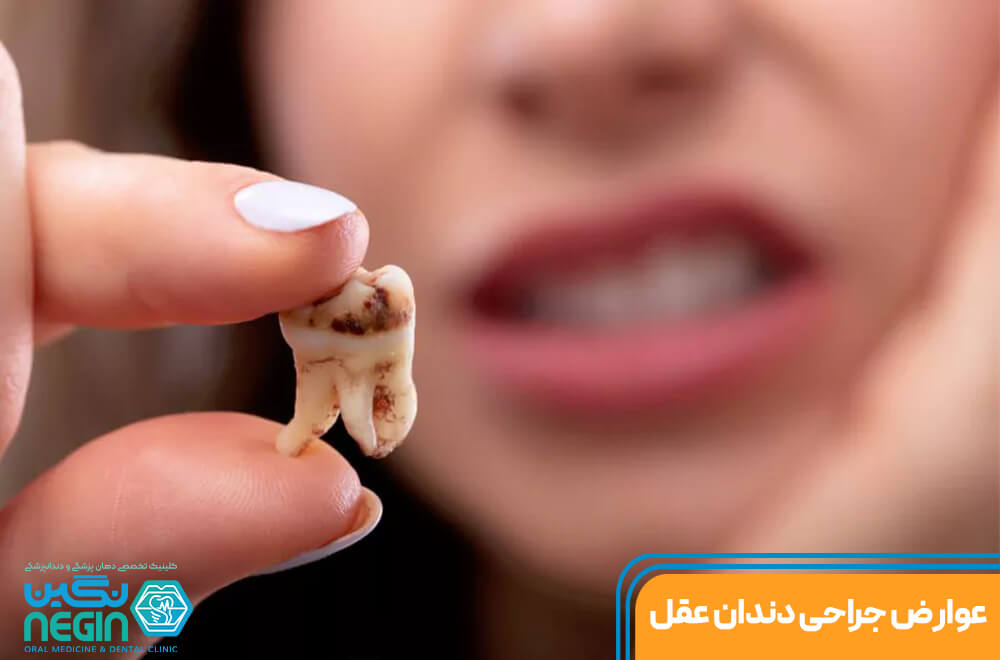 عوارض جراحی دندان عقل در شیراز