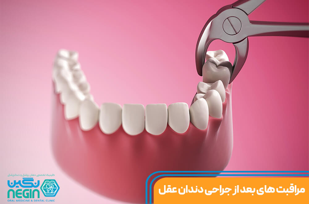مراقبت‌های بعد از جراحی دندان عقل در شیراز