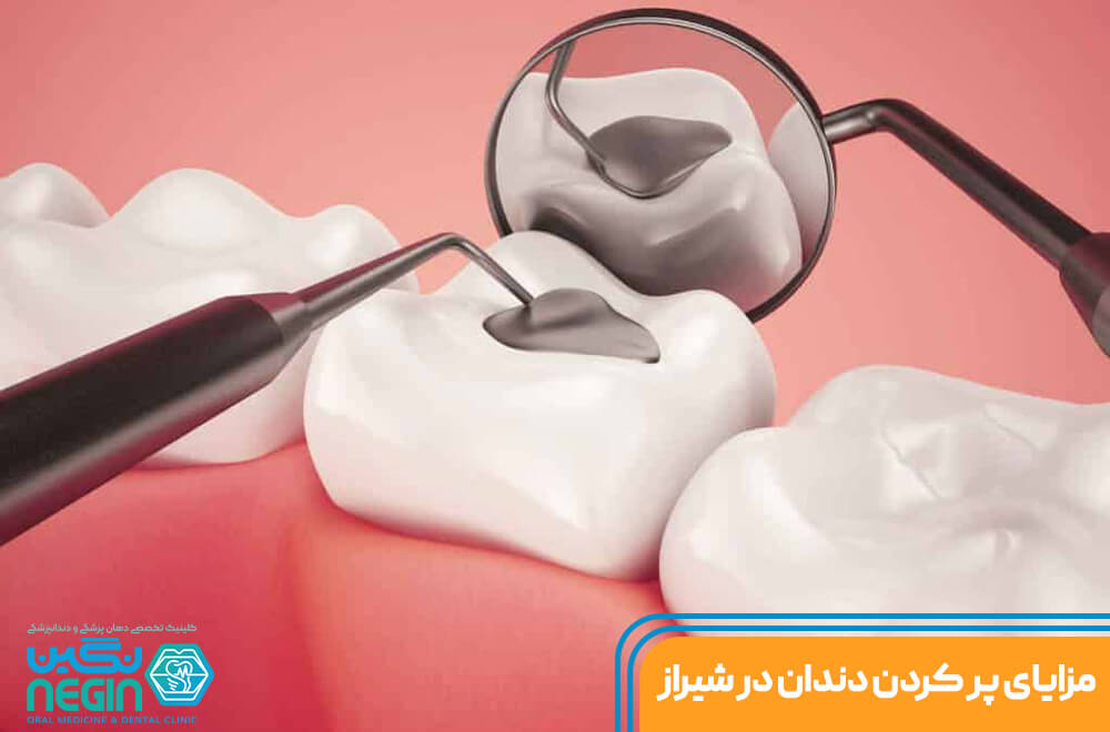 مزایای پر کردن دندان در شیراز