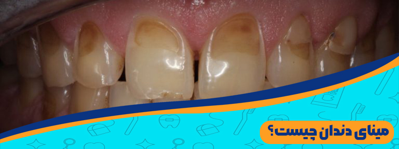 مینای دندان چیست؟ جلوگیری از فرسایش مینای دندان